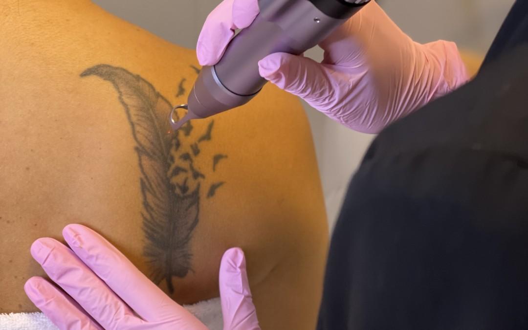 Tatueringsborttagning med Picolaser