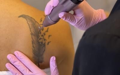 Nytt hos oss, tatueringsborttagning med Picolaser
