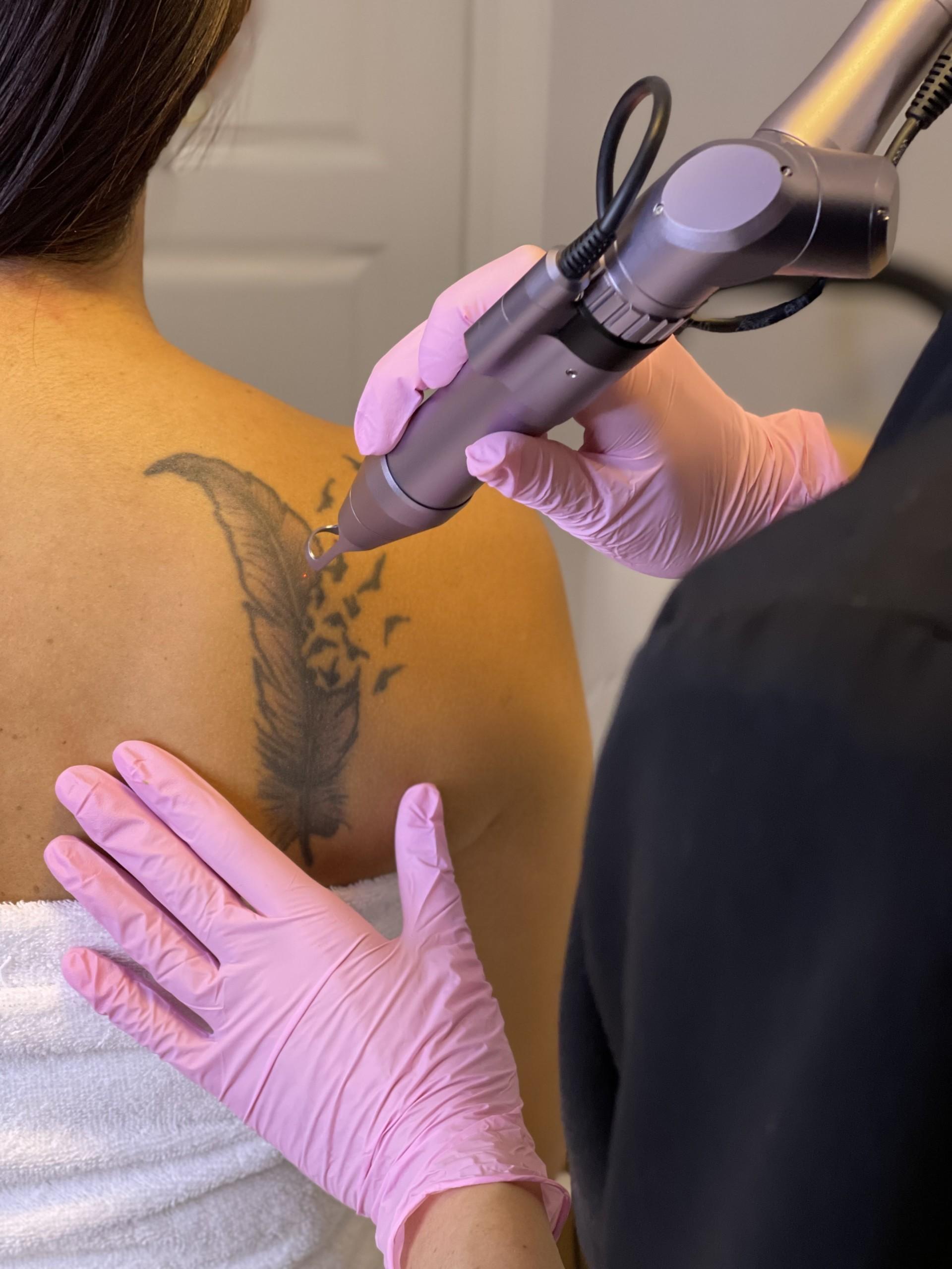 Pico Laser tatueringsborttagning