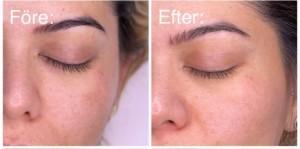 Melasma behandling